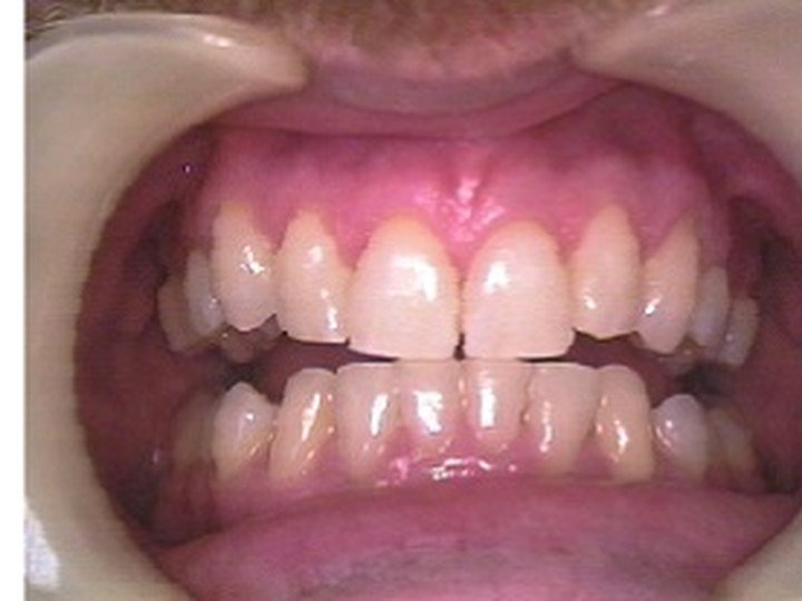 Orthodontic Alignment Example after orthodontic photo