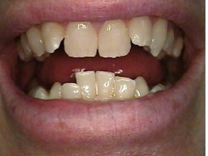 Orthodontic Alignment Example before orthodontic photo