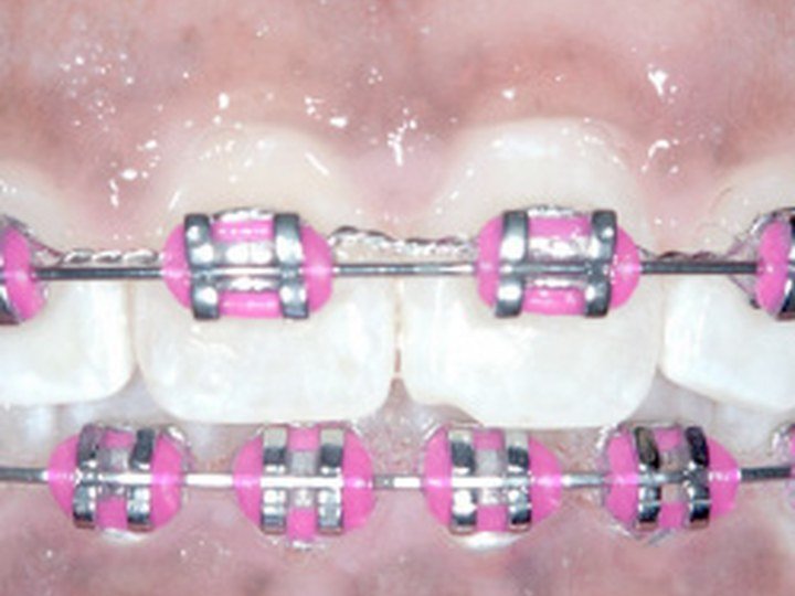 Teeth Gap / Diastema Correction later stage orthodontic photo