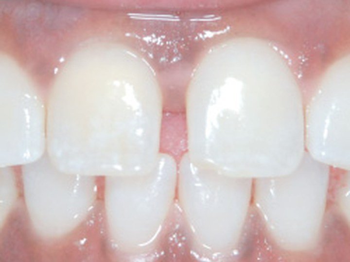 Teeth Gap / Diastema Correction before orthodontic photo
