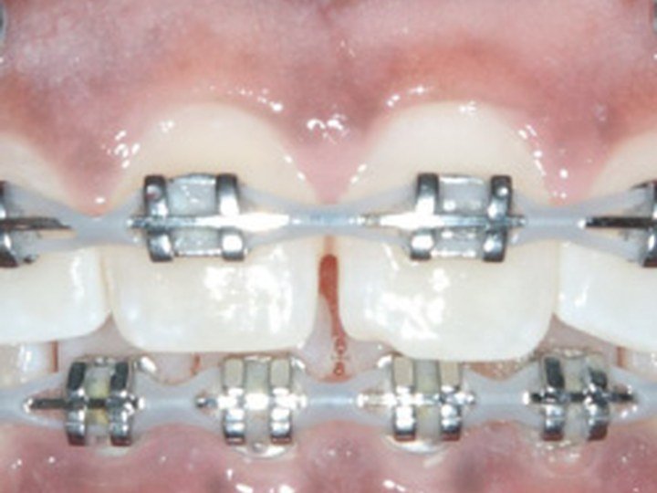 Braces Treatment Progress progress 2 orthodontic photo
