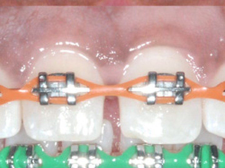Braces Treatment Progress progress 1 orthodontic photo