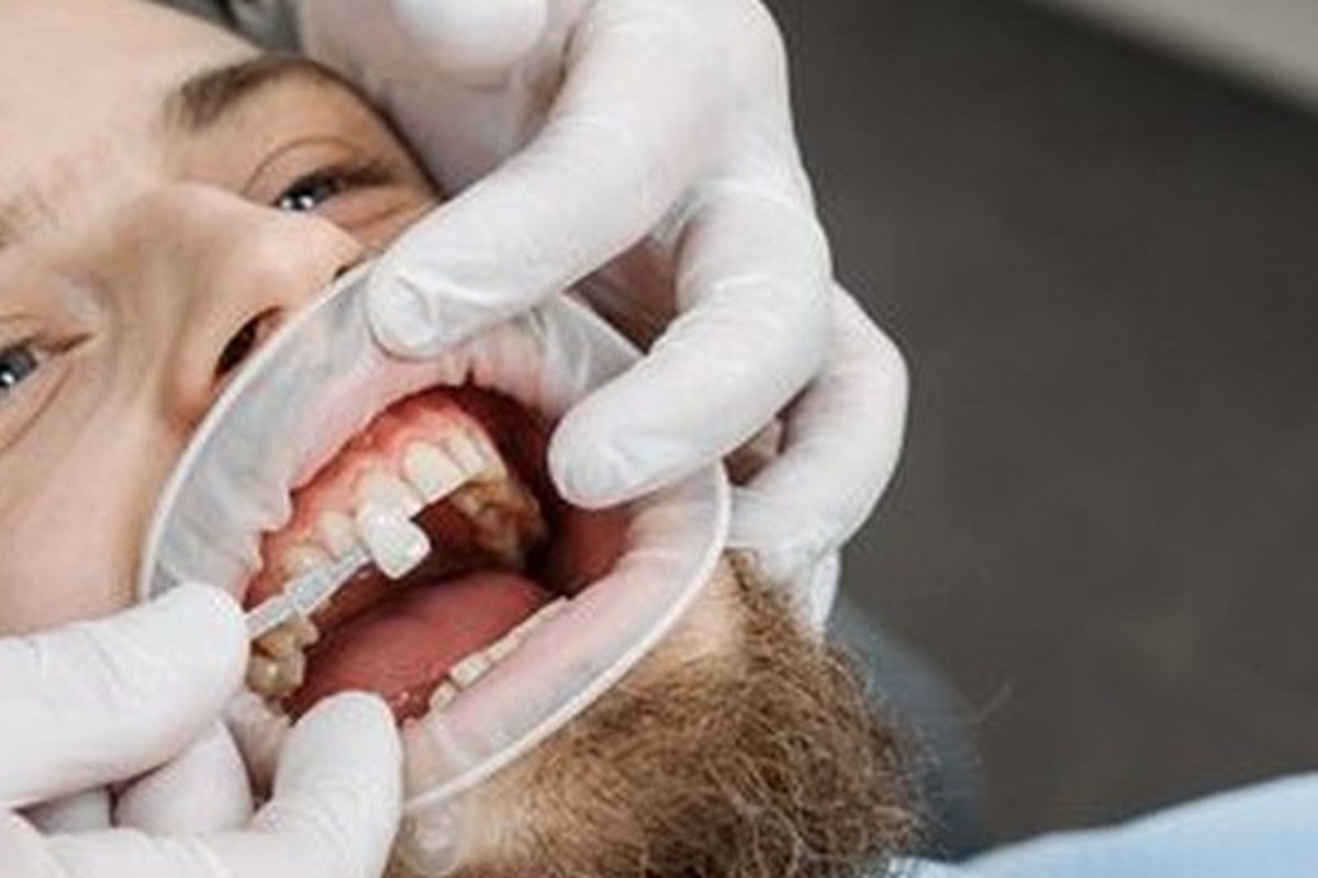 Ceramic Braces