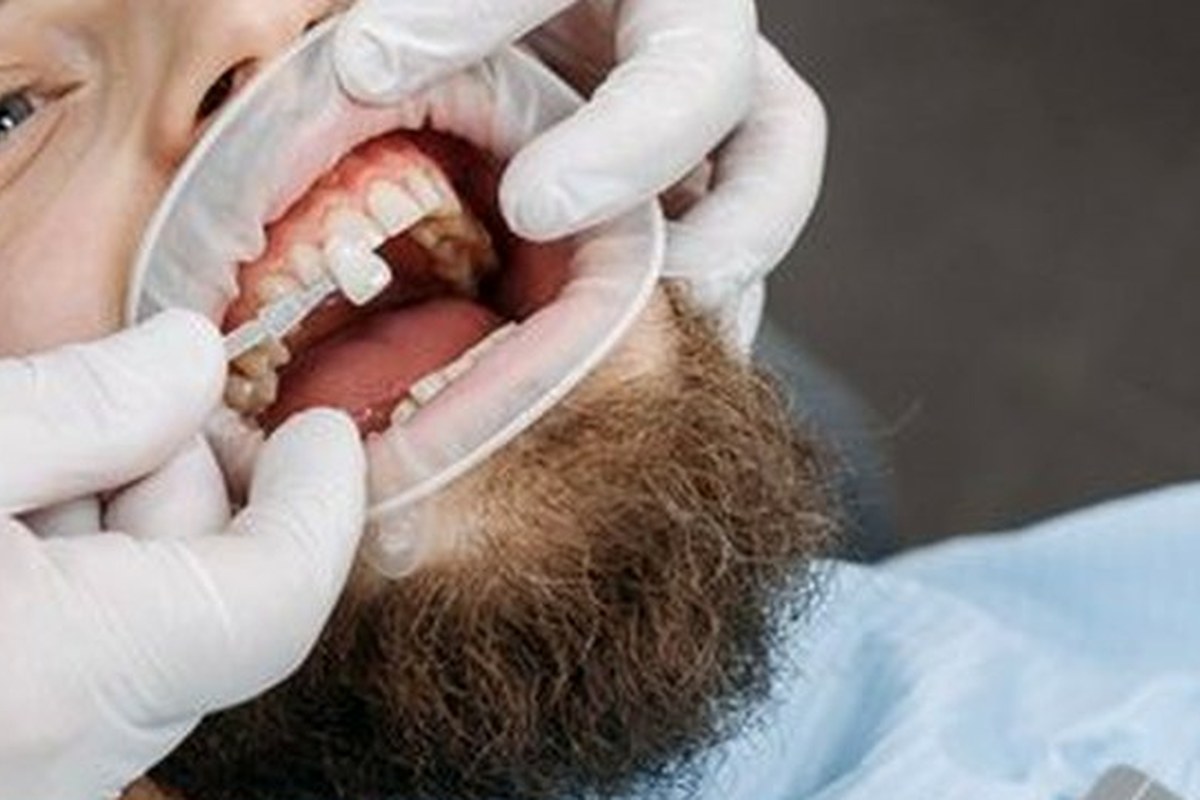 Open Bite Correction